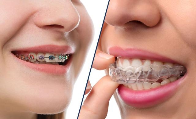 隐形牙套：数字化无托槽隐形矫治技术